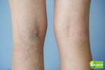 Suy tĩnh mạch là bệnh gì? Có nguy hiểm không? Công dụng Trái Nhàu đối với Suy Tĩ